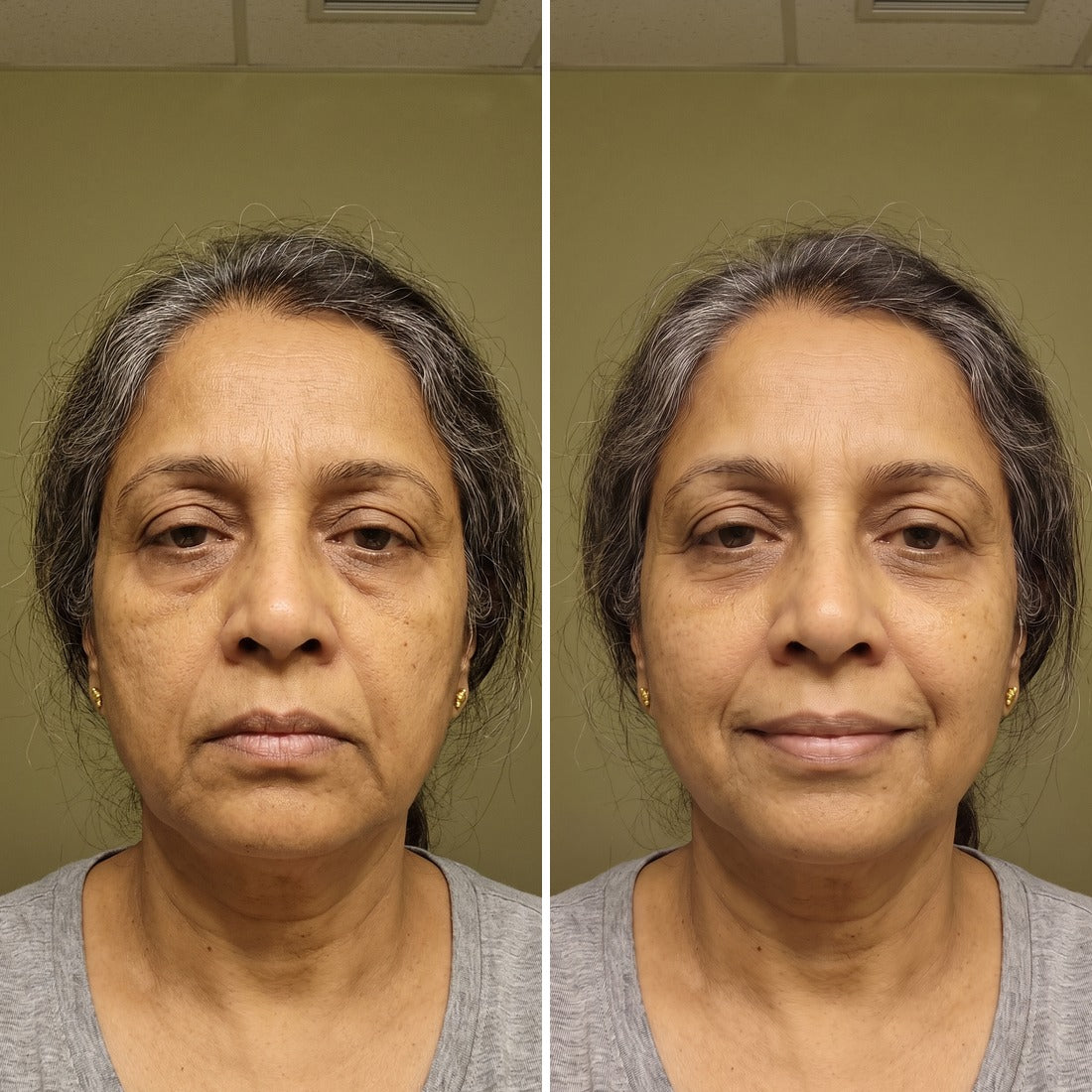 Sunita M. before and after Vitta